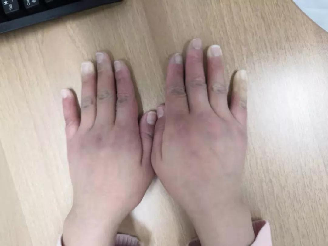 “手指、腳趾發(fā)白、發(fā)紫……”這些“小毛病”千萬別大意